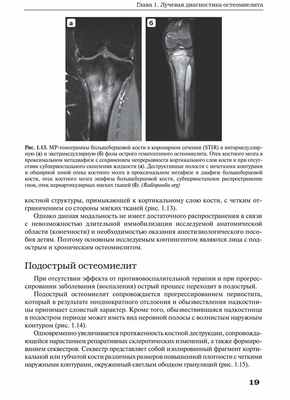 Рис. 1.13. MP-томограммы большеберцовой кости в коронарном сечении (STIR)