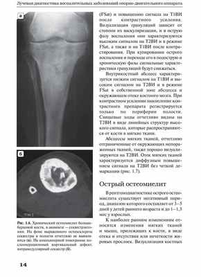 Рис. 1.6. Хронический остеомиелит