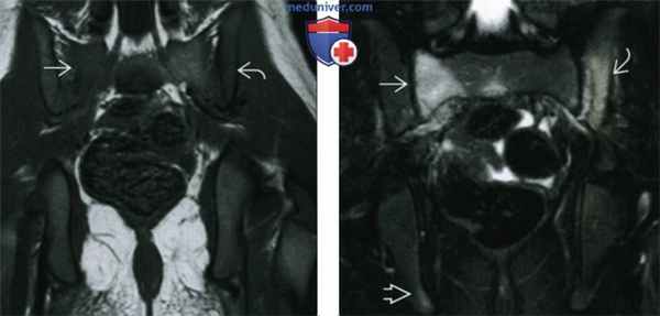 Хронический рецидивирующий многоочаговый остеомиелит - лучевая диагностика