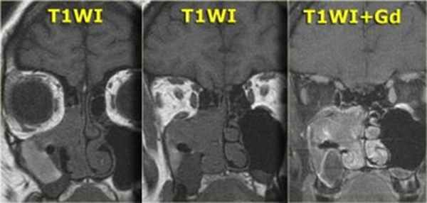  Применение МРТ при заболеваниях придаточных околоносовых пазух