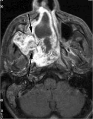  Применение МРТ при заболеваниях придаточных околоносовых пазух