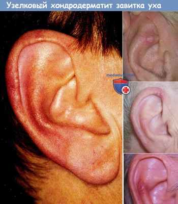 Узелковый хондродерматит завитка уха