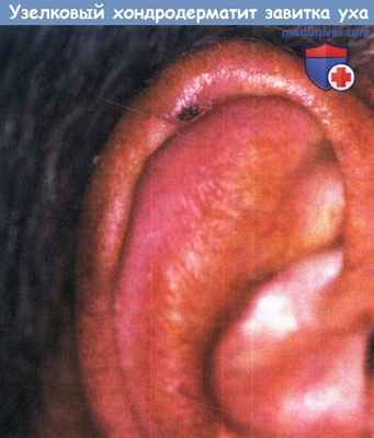 Узелковый хондродерматит завитка уха