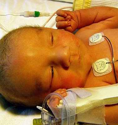 Фото Ядерная желтуха новорожденных