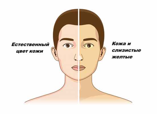 Желтуха болезнь.jpg