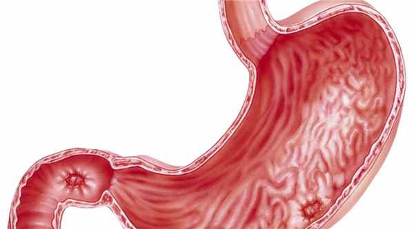 Язва двеннадцатиперстной кишки