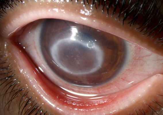 язва роговицы