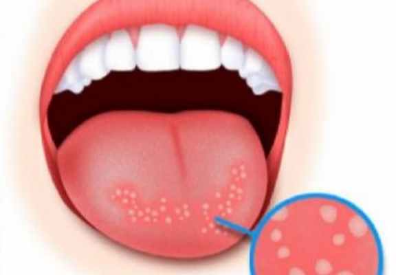 Язвочки в полости рта - Метелица