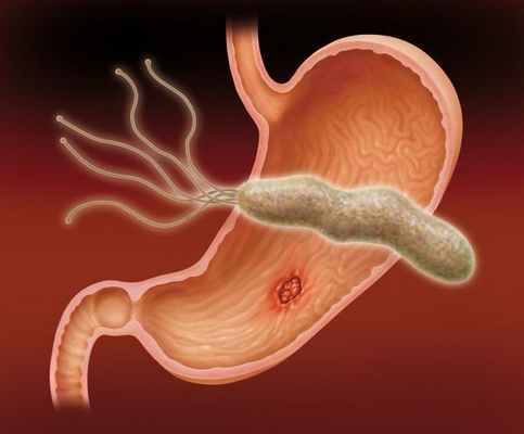 Язвенная болезнь желудка