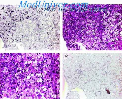апоневротическая фиброма