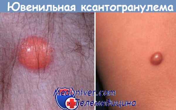 ювенильная ксантогранулема