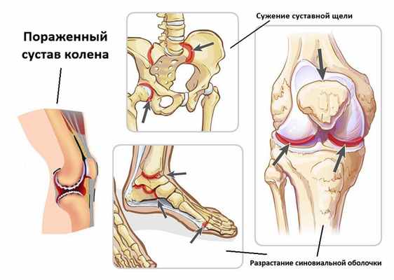 Стадии ювенильного ревматоидного артрита