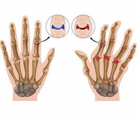 Ювенильный ревматоидный артрит