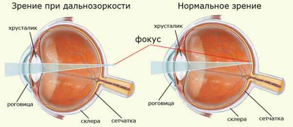Дальнозоркость