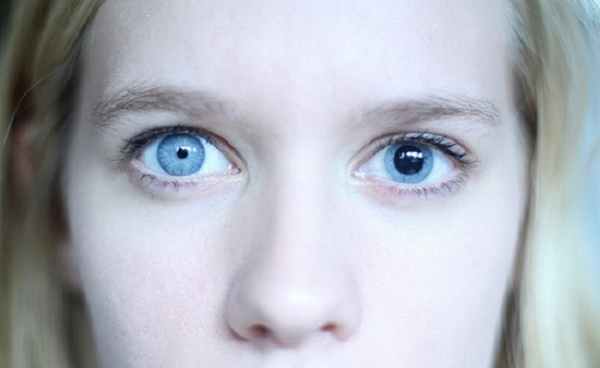 Заболевание глаз - анизокория