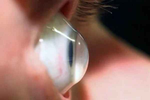 Кератоконус - заболевание роговицы глаза