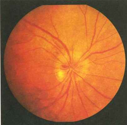 Глазные заболевания - ишемическая нейропатия