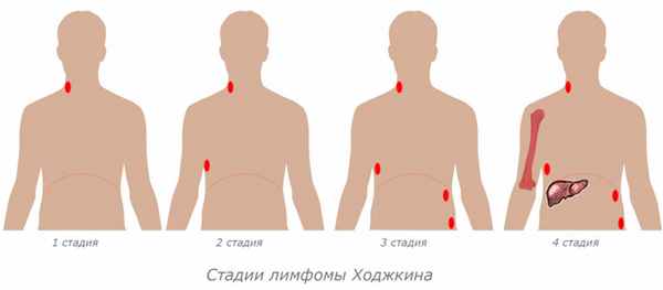 Лимфома Ходжкина.jpg