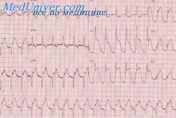 инфаркт миокарда
