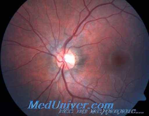 хориоретинит при токсокарозе