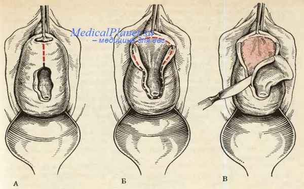 Зашивание шеечно-влагалищного свища по Елъцову-Стрелкову