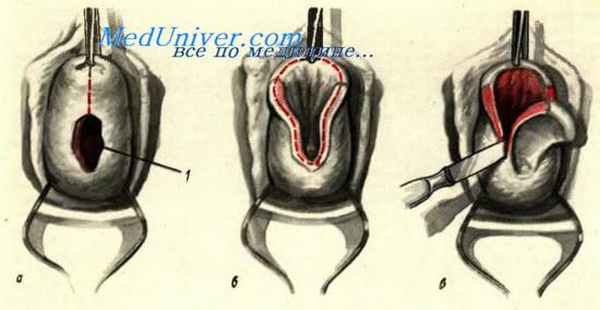 Зашивание шеечно-влагалищных свищей