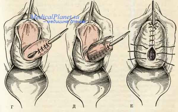 Зашивание шеечно-влагалищного свища по Елъцову-Стрелкову