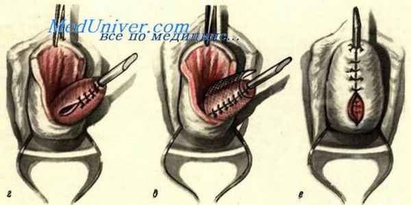 Зашивание шеечно-влагалищных свищей
