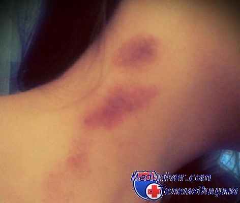 Засос на шее