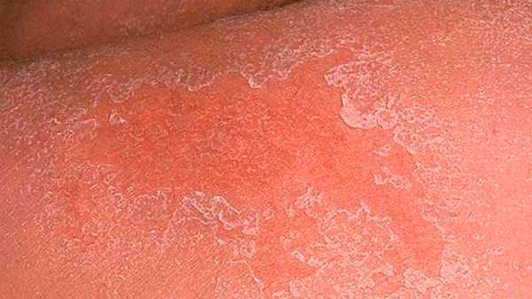 Варикозный дерматит 2 стадия