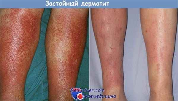Застойный дерматит