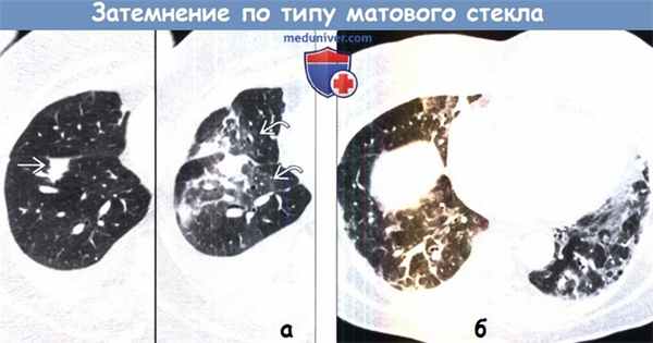 Компьютерная томография затемнения по типу матового стекла