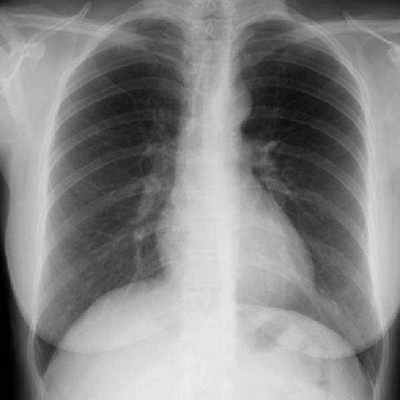 Нормальный легочный рисунок