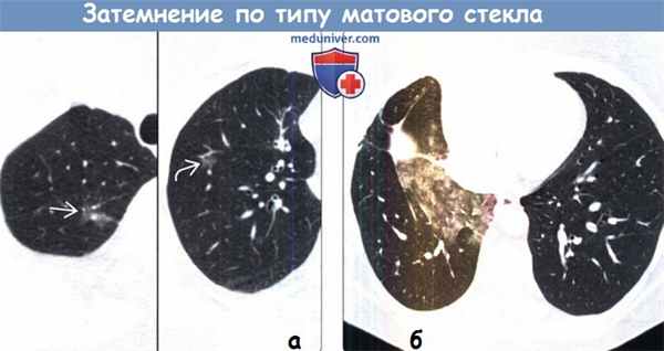 Компьютерная томография затемнения по типу матового стекла