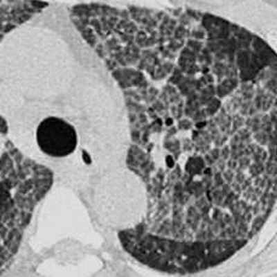 симптом булыжной мостовой