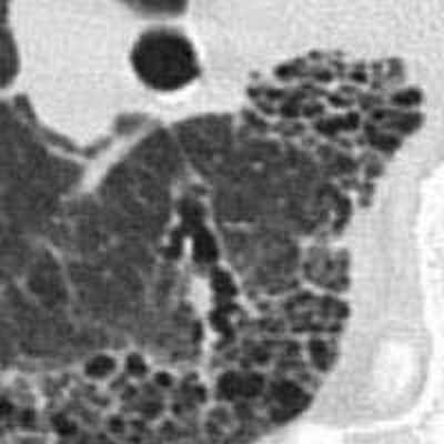 сотовое легкое