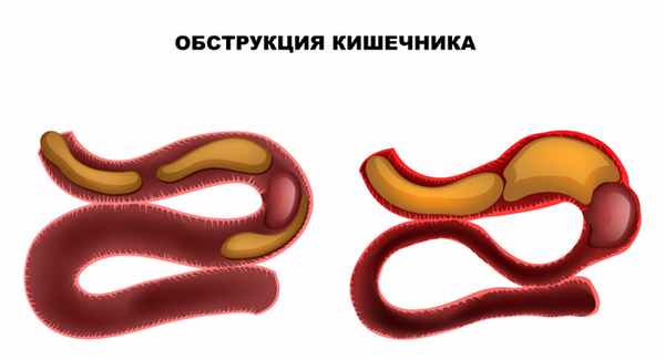 Обструкция кишечника.jpg