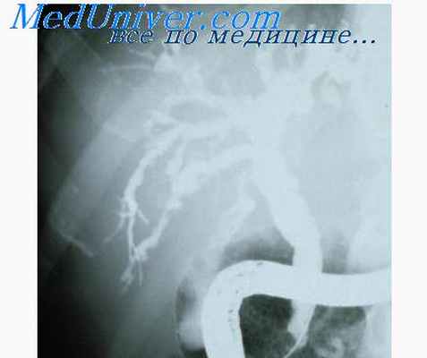 желтуза при эхинокококке