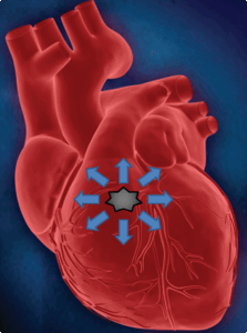 желудочковая экстрасистолия