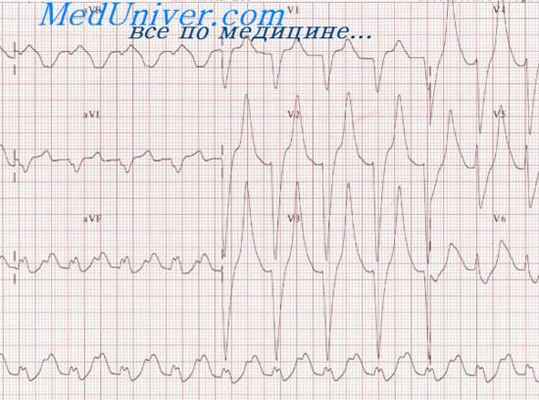 экстрасистолия при алкоголизме