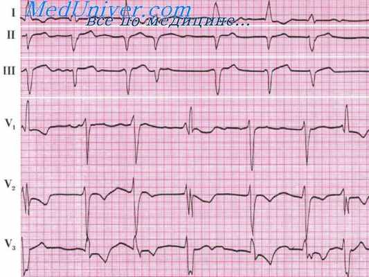желудочковая парасистолия