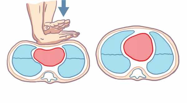 Желудочковая тахикардия