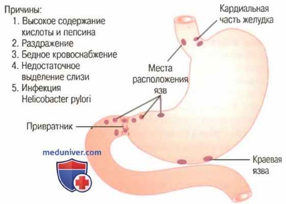 Желудочная атрофия. Пептическая язва