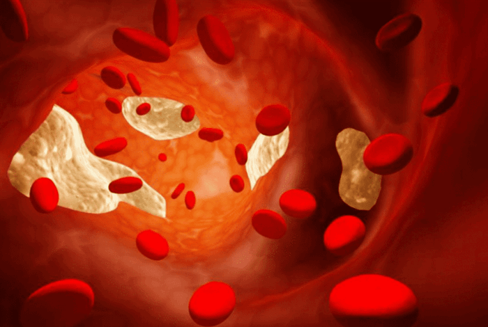 Жировая эмболия - симптомы, лечение, причины болезни, первые признаки