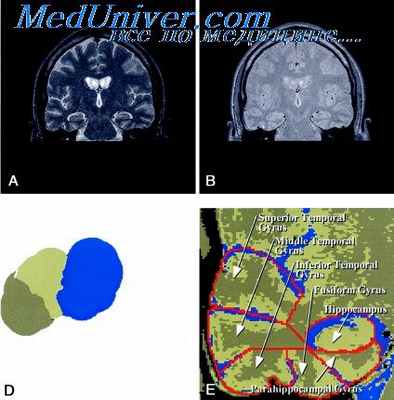 жировая эмболия