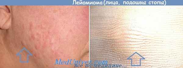 злокачественная лейомиома