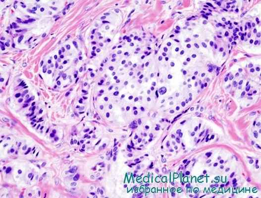 инсулинома