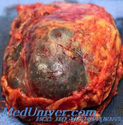 кортикостеромы