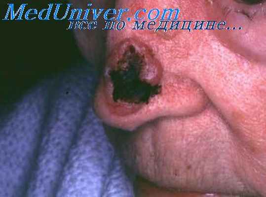 хондрома носа