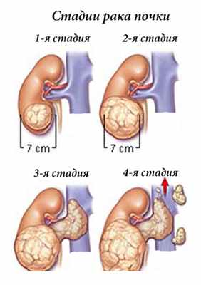 Стадии рака почки